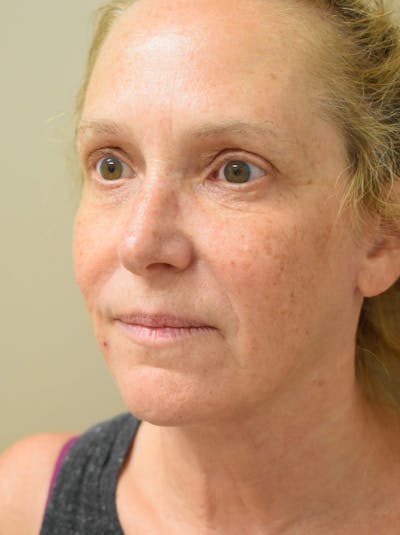 Facelift Before & After Gallery - Patient 335039 - Image 10