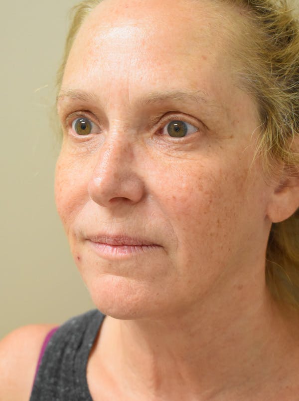 Facelift Before & After Gallery - Patient 335039 - Image 10