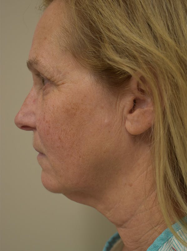 Facelift Before & After Gallery - Patient 335039 - Image 11