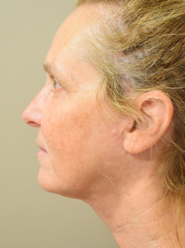 Facelift Before & After Gallery - Patient 335039 - Image 12