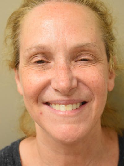Facelift Before & After Gallery - Patient 335039 - Image 4