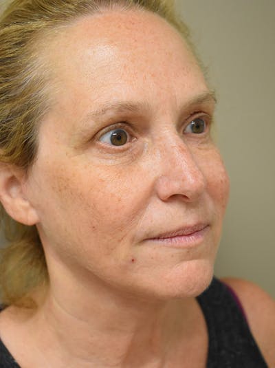 Facelift Before & After Gallery - Patient 335039 - Image 6