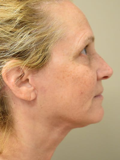 Facelift Before & After Gallery - Patient 335039 - Image 8