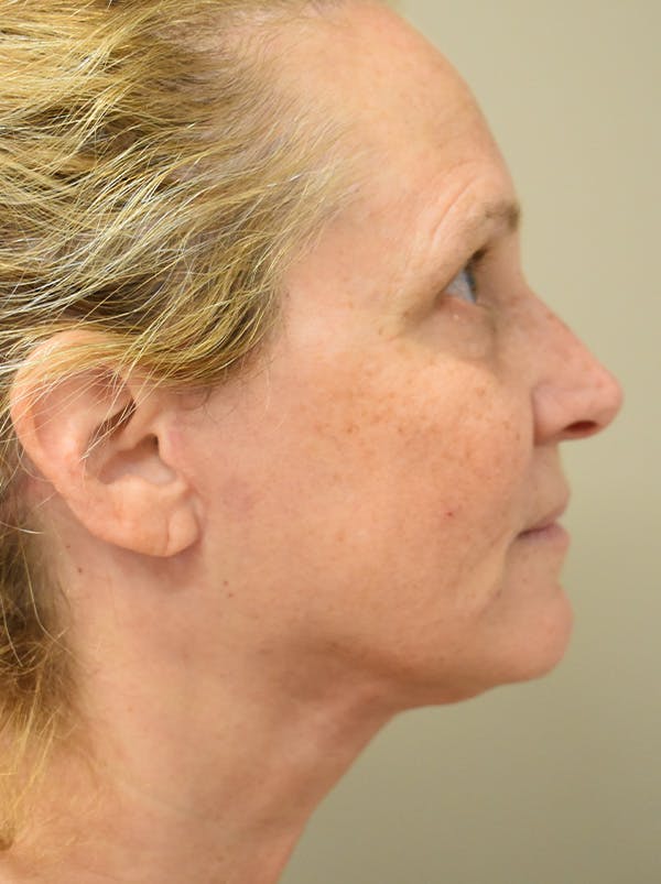 Facelift Before & After Gallery - Patient 335039 - Image 8