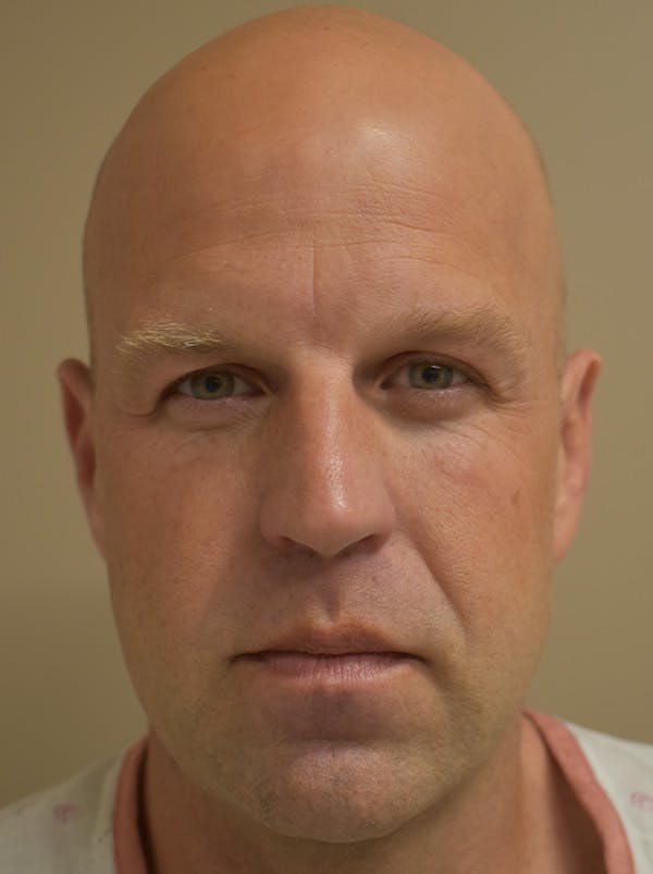Facelift Before & After Gallery - Patient 135778 - Image 1