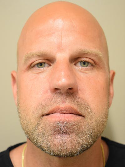 Facelift Before & After Gallery - Patient 135778 - Image 2