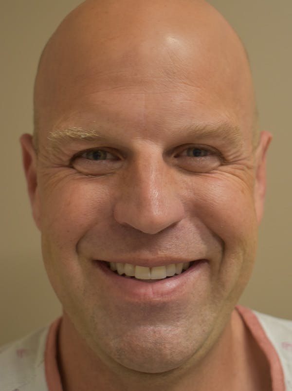 Facelift Before & After Gallery - Patient 135778 - Image 3