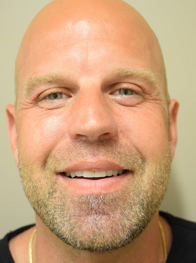 Facelift Before & After Gallery - Patient 135778 - Image 4