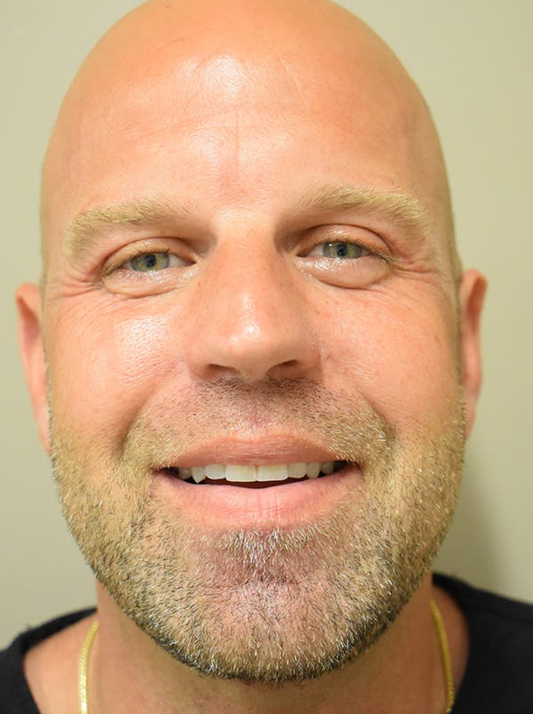 Facelift Before & After Gallery - Patient 135778 - Image 4