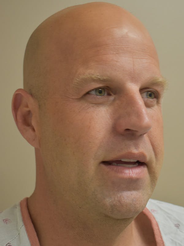 Facelift Before & After Gallery - Patient 135778 - Image 5