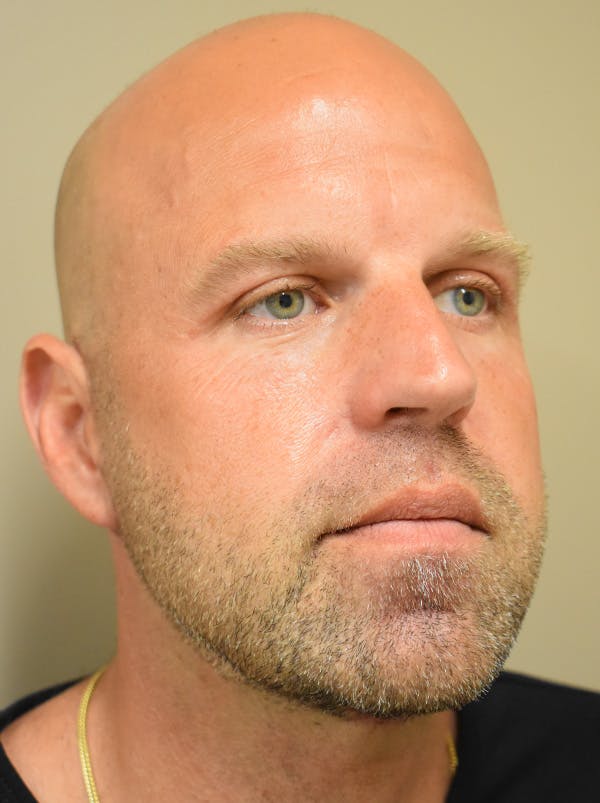 Facelift Before & After Gallery - Patient 135778 - Image 6
