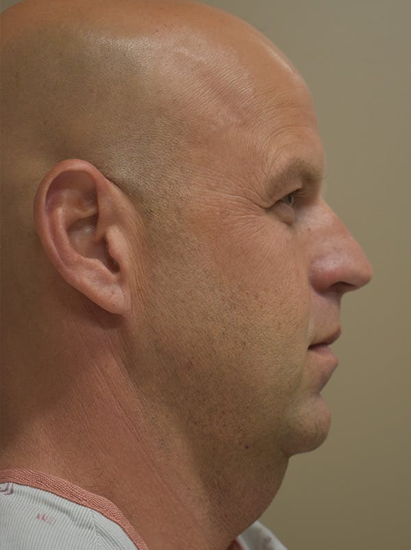 Facelift Before & After Gallery - Patient 135778 - Image 7