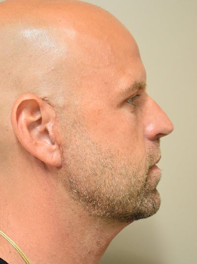 Facelift Before & After Gallery - Patient 135778 - Image 8