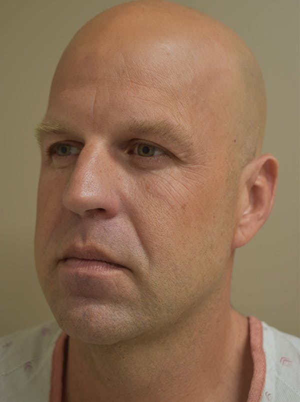 Facelift Before & After Gallery - Patient 135778 - Image 9