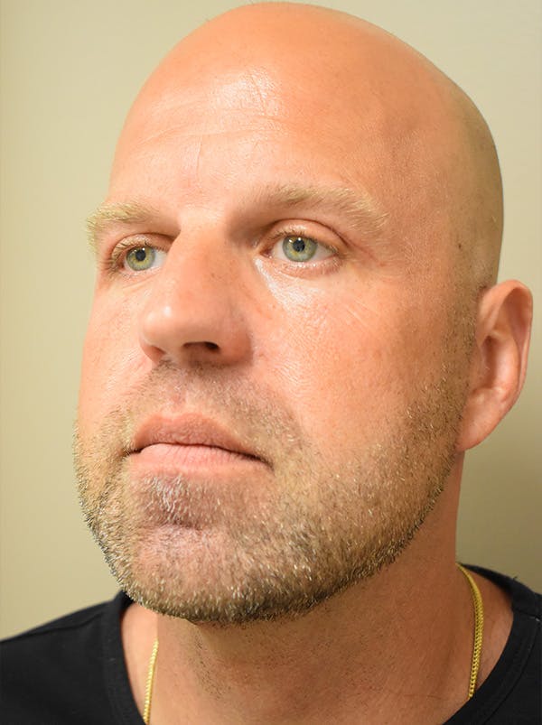 Facelift Before & After Gallery - Patient 135778 - Image 10