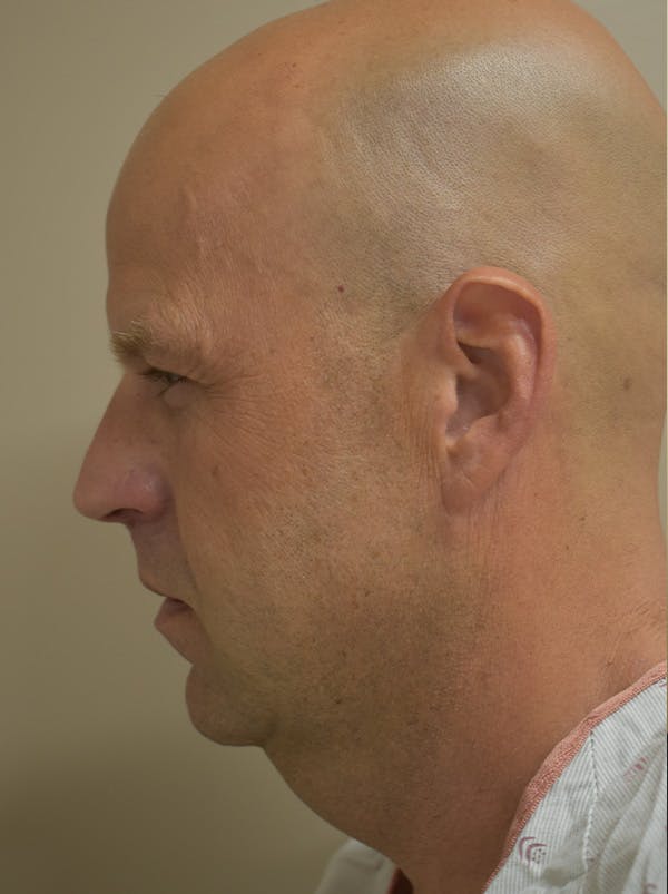 Facelift Before & After Gallery - Patient 135778 - Image 11