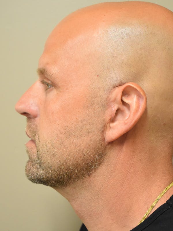 Facelift Before & After Gallery - Patient 135778 - Image 12