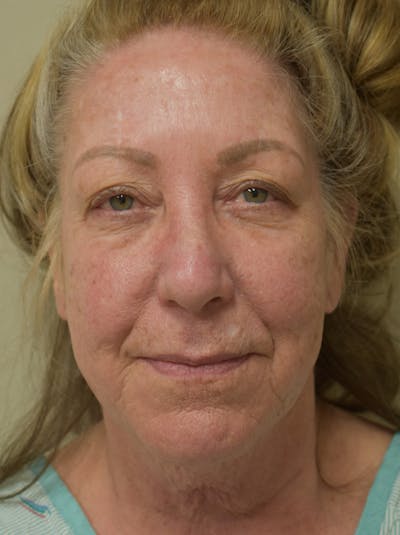 Facelift Before & After Gallery - Patient 328058 - Image 1