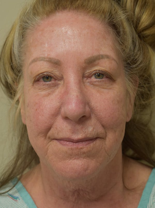 Facelift Before & After Gallery - Patient 328058 - Image 1