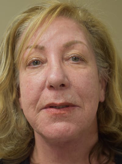 Facelift Before & After Gallery - Patient 328058 - Image 2