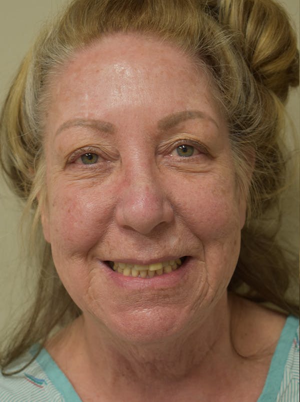 Facelift Before & After Gallery - Patient 328058 - Image 3