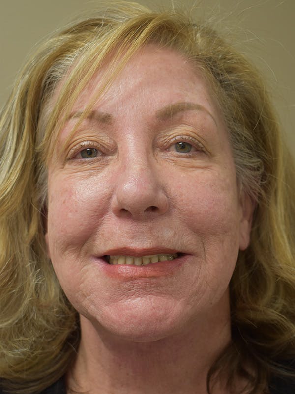 Facelift Before & After Gallery - Patient 328058 - Image 4