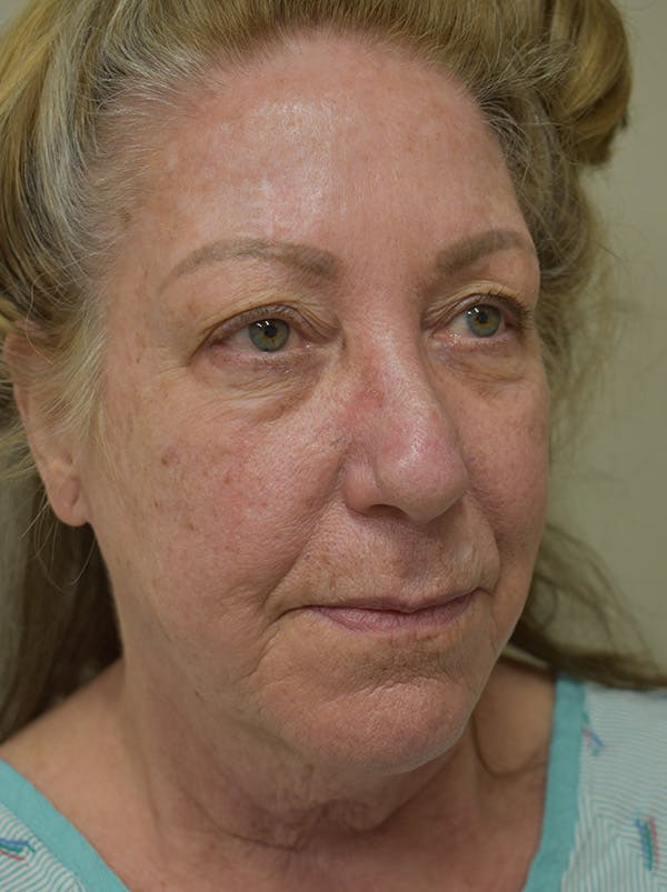 Facelift Before & After Gallery - Patient 328058 - Image 5