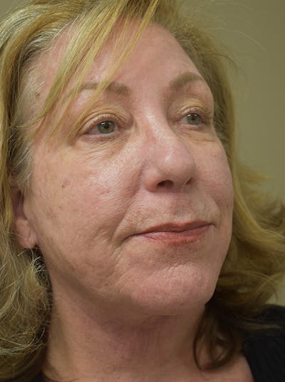 Facelift Before & After Gallery - Patient 328058 - Image 6