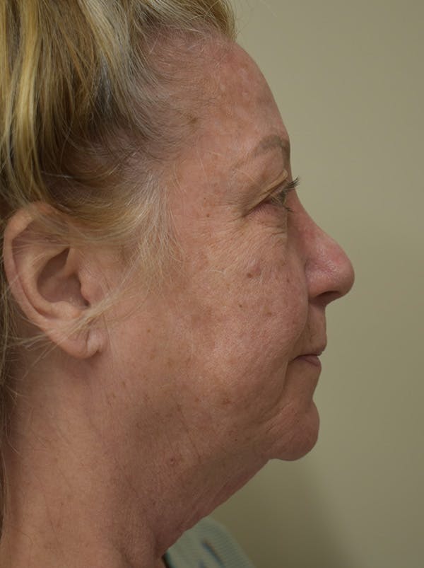 Facelift Before & After Gallery - Patient 328058 - Image 7