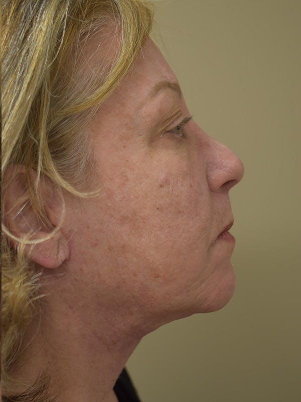 Facelift Before & After Gallery - Patient 328058 - Image 8