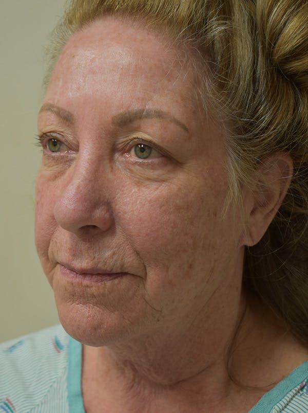 Facelift Before & After Gallery - Patient 328058 - Image 9