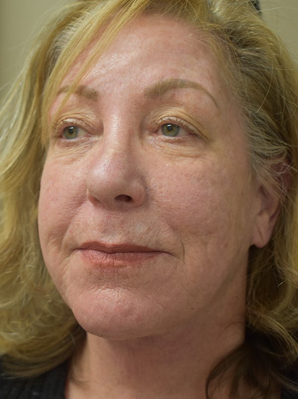 Facelift Before & After Gallery - Patient 328058 - Image 10