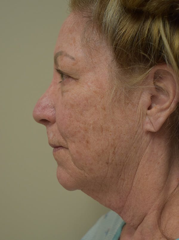 Facelift Before & After Gallery - Patient 328058 - Image 11