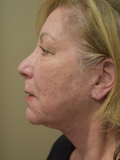 Facelift Before & After Gallery - Patient 328058 - Image 12