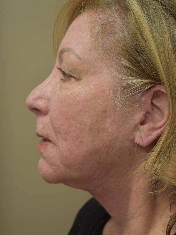 Facelift Before & After Gallery - Patient 328058 - Image 12