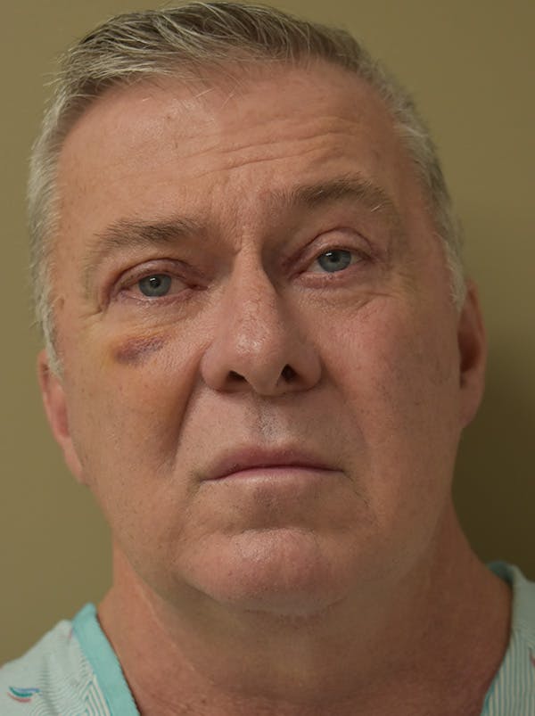 Facelift Before & After Gallery - Patient 410783 - Image 3