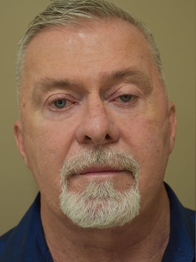 Facelift Before & After Gallery - Patient 410783 - Image 4
