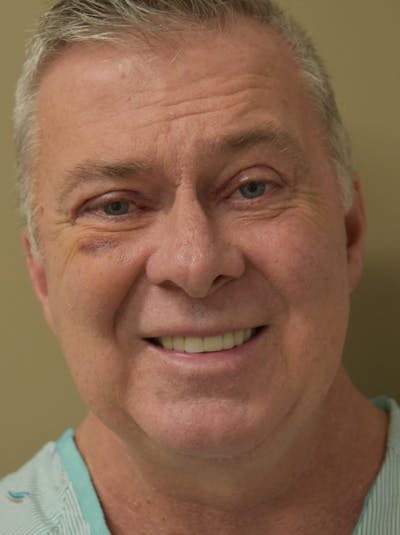 Facelift Before & After Gallery - Patient 410783 - Image 1
