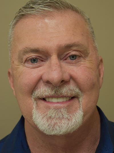 Facelift Before & After Gallery - Patient 410783 - Image 2
