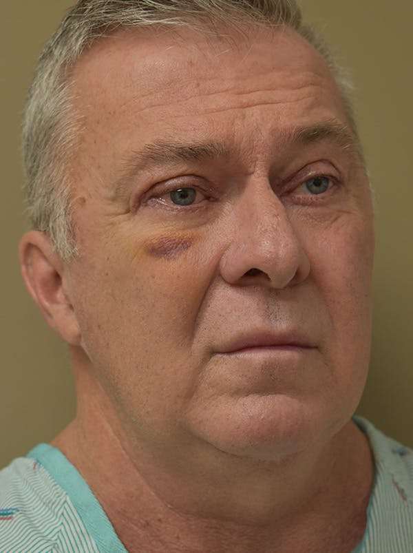 Facelift Before & After Gallery - Patient 410783 - Image 5