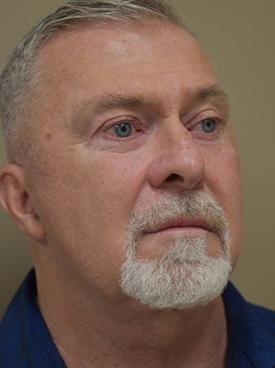 Facelift Before & After Gallery - Patient 410783 - Image 6