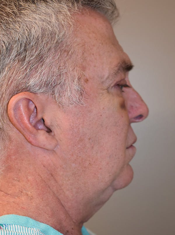 Facelift Before & After Gallery - Patient 410783 - Image 7