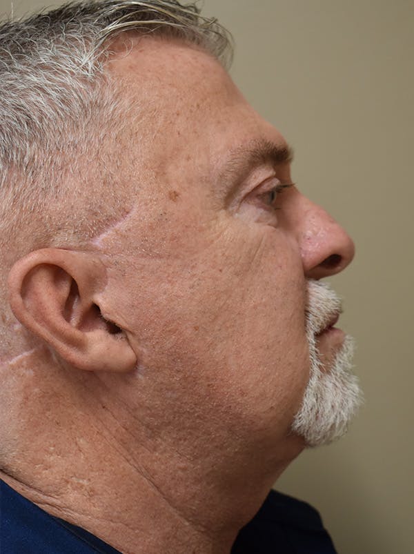 Facelift Before & After Gallery - Patient 410783 - Image 8