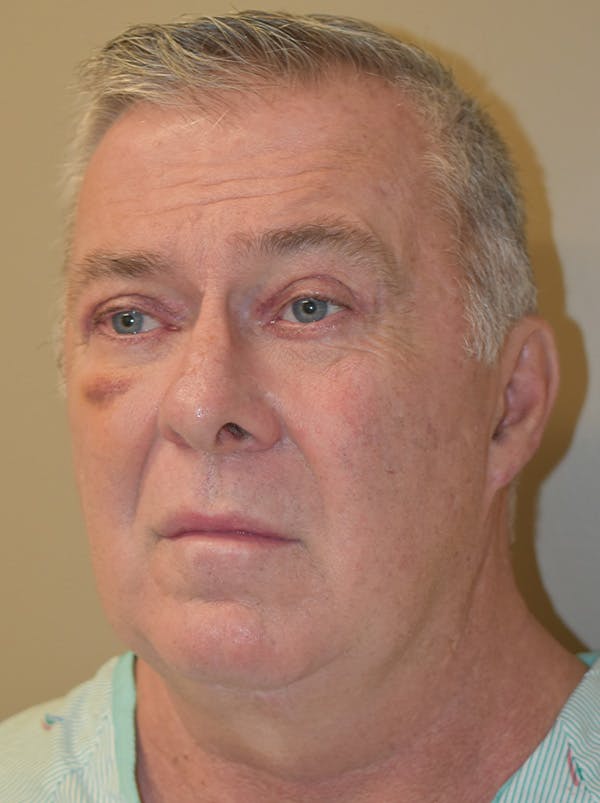 Facelift Before & After Gallery - Patient 410783 - Image 9
