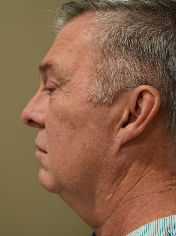 Facelift Before & After Gallery - Patient 410783 - Image 11