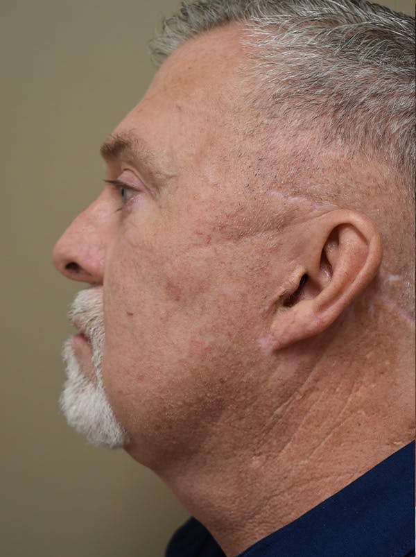 Facelift Before & After Gallery - Patient 410783 - Image 12