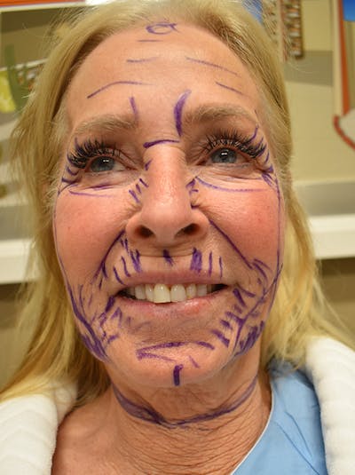 Facelift Before & After Gallery - Patient 141102 - Image 1