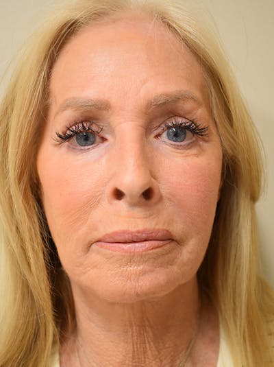 Facelift Before & After Gallery - Patient 141102 - Image 2