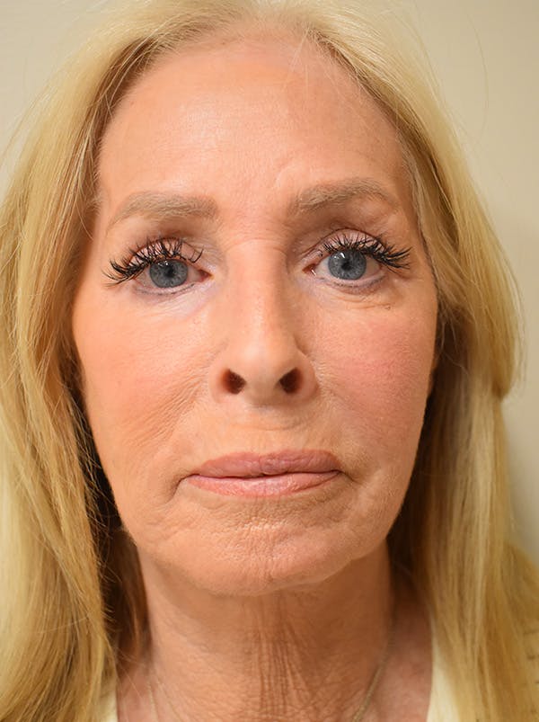 Facelift Before & After Gallery - Patient 141102 - Image 2