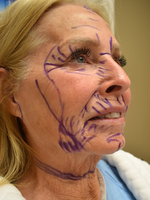 Facelift Before & After Gallery - Patient 141102 - Image 3